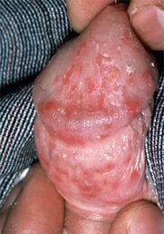 soorist tingitud eritis peenisest